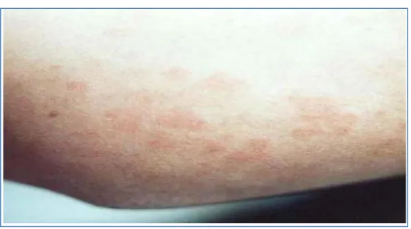 Figure 17 : Éruption cutanée typique du bras dans la maladie de Still à l'âge adulte [12]  L’examen histologique des lésions cutanées n’est pas très contributif