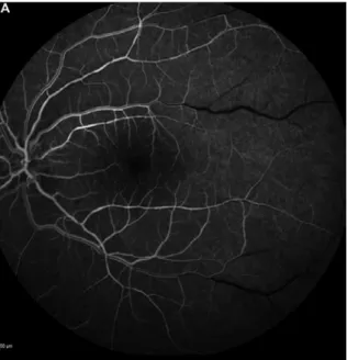 Figure n°13 : Maladie de Behcet. Angiographie à la fluorescéine objectivant une vascularite  veineuse de l’arcade temporale inférieure, avec diffusion angiographique