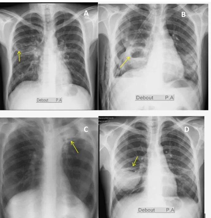 Figure 14 : Aspect des opacités excavées à la radiographie standard.  A : opacité excavée  parahilaire aérique (tuberculose pulmonaire),  