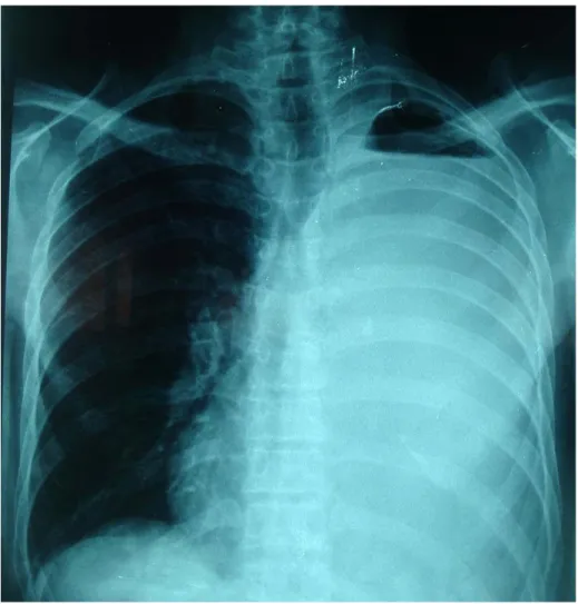 Figure 5: Radiographie thoracique de face 1 : hydropneumothorax gauche de grande abondance  (Service de chirurgie thoracique HMA Marrakech) 