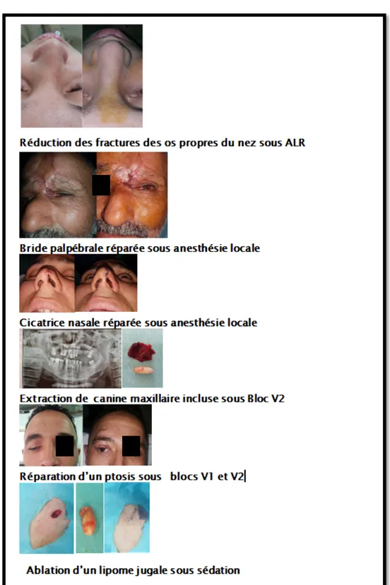 Figure  18 : Photos des différents actes opératoires réalisés en ambulatoire 