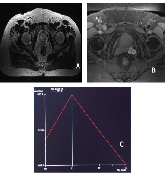 Figure  22   : IRM prostatique en coupe axiale T2 (A), T1 après injection de GADO (B), Courbe  dynamique (C) montrant : un nodule hypo-intense  T2  de la base et la partie médiane de la  prostate  périphérique postéro-médiane intéressant  les secteurs 1p3p