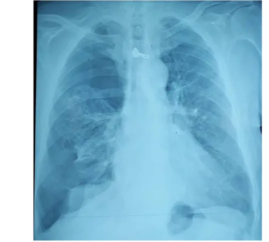 Figure 6 : Radiographie thoracique de face : pneumothorax droit cloisonné avec bulles  d’emphysème Service chirurgie thoracique HMA 