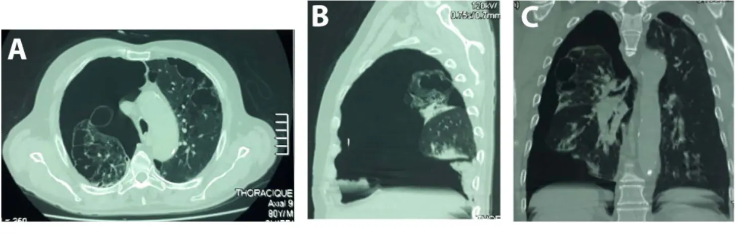 Figure  9TDM thoracique:PNO droit cloisonné de grande abondance avec emphysème  pulmonaire bulleux bilatéral