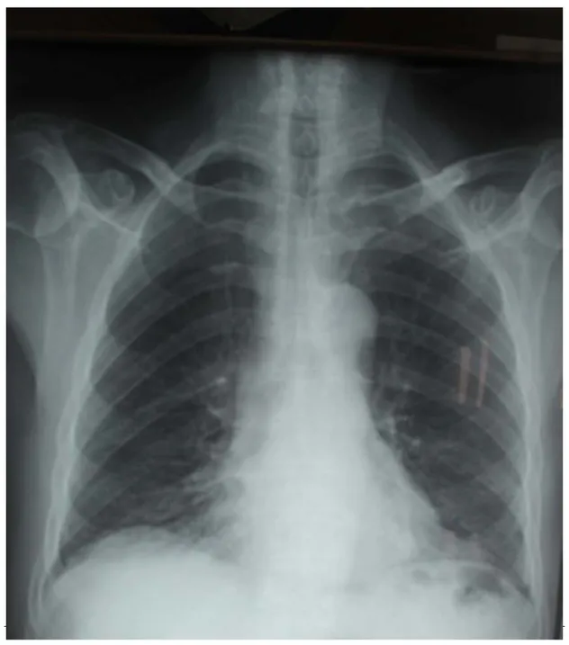 Figure 14 : Ré-expansion complète du poumon après retrait du drain   Service chirurgie thoracique HMA 