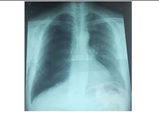 Figure 15 : Radiographie thoracique de face : défaut de ré-expansion pulmonaire après  drainage thoracique Service chirurgie thoracique HMA 