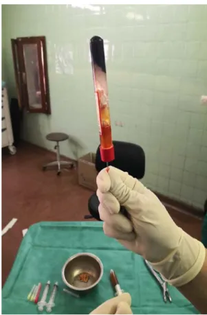 Figure 12 :  Préparation du PRP ATS (sérum à thrombine activée) 