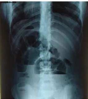 Figure 09: AXR of 12 years old child showing both central and peripheral Air-fluid levels  