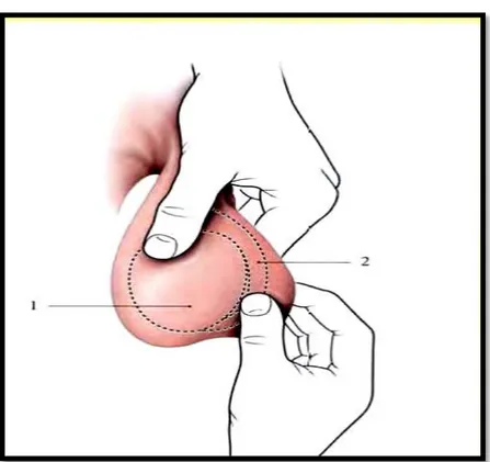 Figure 7 : Palpation du scrotum et du contenu scrotal [49]. 1. Testicule 2. Épididyme 
