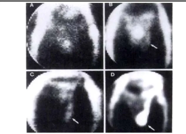 Figure 10 : Aspect descintigraphie des différents grades de varicocèle [60]. A. Grade 0 (normal),  B