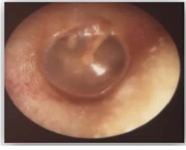 Figure N°15 : Otoscopie normale