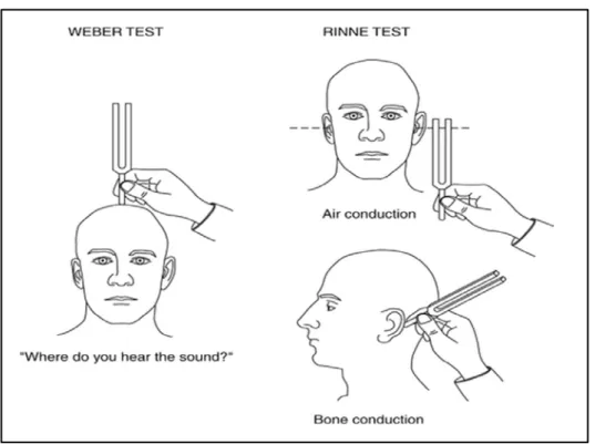 Figure N°16 : Tests de Weber et Rinne [23] 