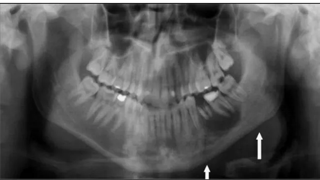 Figure 7 : Radiographie panoramique dentaire montrant une lésion lacunaire opaque en regard  des dents 35 et 36.Remarquez la fracture pathologique (flèche blanches)
