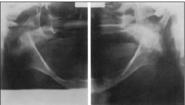 Figure 8 : Radiographie panoramique dentaire révèle une atrophie mandibulaire avec double  fractures pathologiques, une déplacée de la 1 er