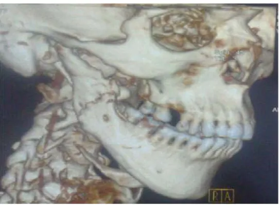 Figure 10 : Reconstruction 3D confirme la présence d’une fracture non disloqué du corps droit  de la mandibule