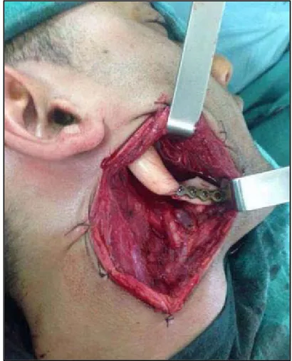 Figure 14 : Photo per opératoire montrant une reconstruction d’une mandibulectomie terminale  par endoprothèse fixée par plaque d’ostéosynthèse