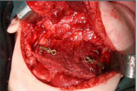 Figure 15 : Vue per opératoire d’une reconstruction mandibulaire par une greffe iliaque fixée par  plaque