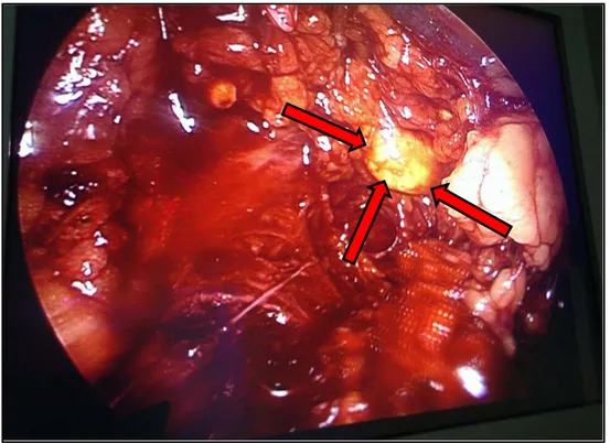 Figure 17 : Vue coelioscopique correspondant à un adénome de Conn (flèche rouge)        Bloc d’Urologie - HMA