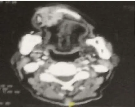 Figure 13: TDM faciale en coupe axiale (fenêtre osseuse) montrant un processus ostéolytique  centrée sur l’os maxillaire droit 