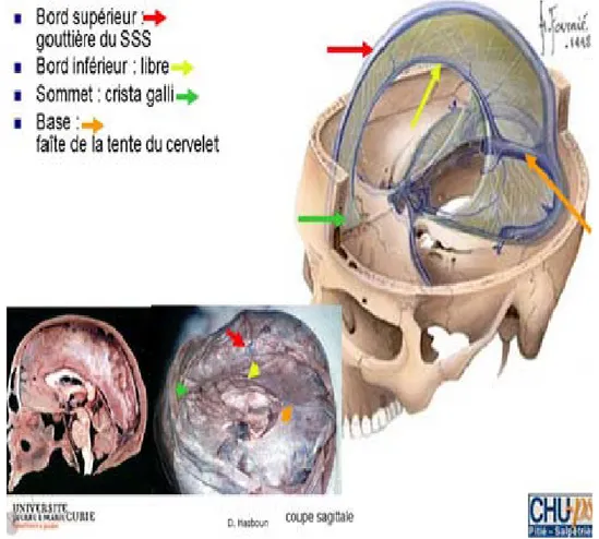 Figure 2 [5] : tente du cervelet et sinus à droite, et à gauche : coupe sagittal du crane 