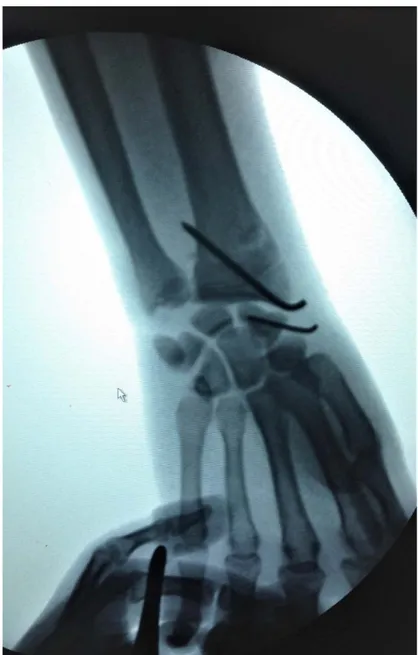 Figure 15 Radiographie de face post opératoire d’un double embrochage de l’extrémité distale  du radius et du scaphoïde 