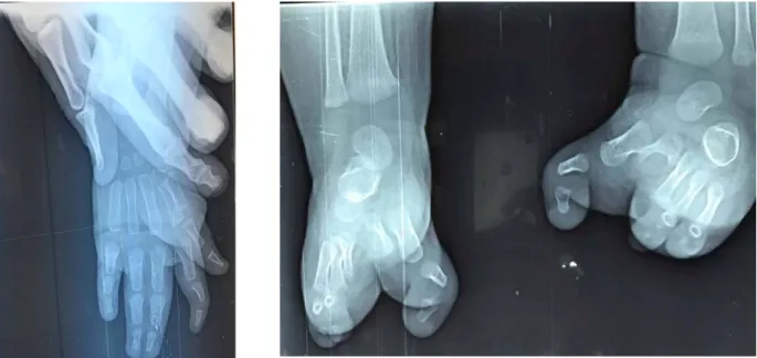 Figure 7 : Deux radiographies faites chez un malade avec un syndrome poly malformatif   montrant : 