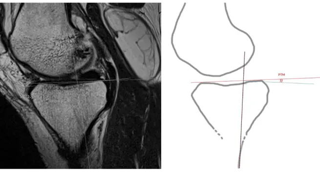 Figure 8 : La pente tibiale médiale sur une couple sagittale médiale 