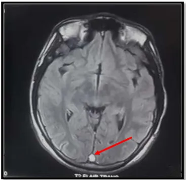 Figure 18 : IRM cérébrale en séquence pondérée T2 FLAIR selon un plan axial : montre une  thrombose du sinus longitudinal supérieur