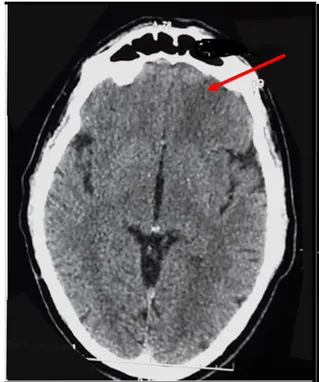 Figure 22 : TDM cérébrale (09/11/16) : montre une hypodensité mal systématisée frontale  gauche évoquant un AVC d’origine veineuse 