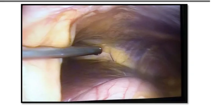 Figure 11 : Instillation de la coupole diaphragmatique gauche par de la lidocaine 2%.  (Iconographie du service de chirurgie générale de l'HMA)