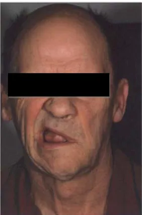 Figure 11 : Paralysie faciale périphérique gauche avec signe de Charles Bell[7] 