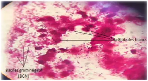 Figure 6: Vaginite bactérienne 