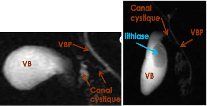 Figure 20 : Disposition typique de la VB et du canal cystique en bili-IRM 