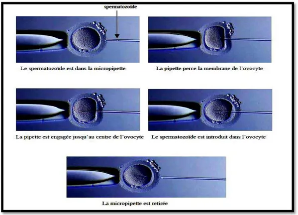 Figure 4 : Les différentes étapes d’une injection intra cytoplasmique de spermatozoïde [10] 