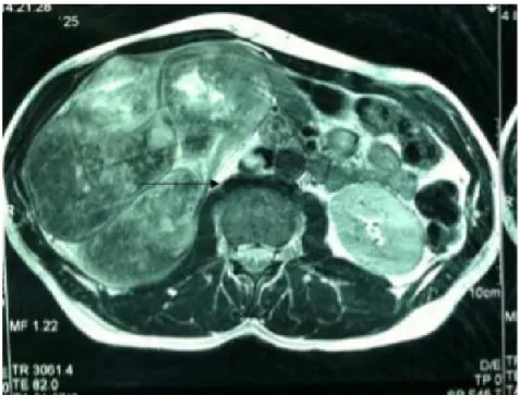 Figure 19 : IRM abdominale objectivant un énorme processus rénal droit    avec thrombus cave (flèche) 