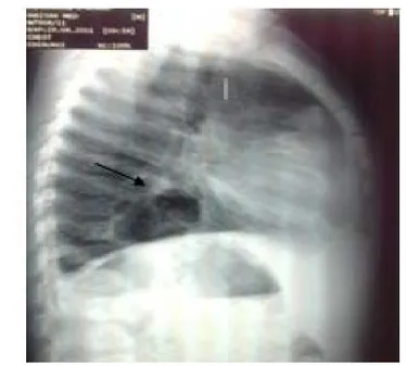 Figure 8 :Radiographie thoracique de profil montrant une clarté digestive  à projection postérieure chez un patient de notre série 