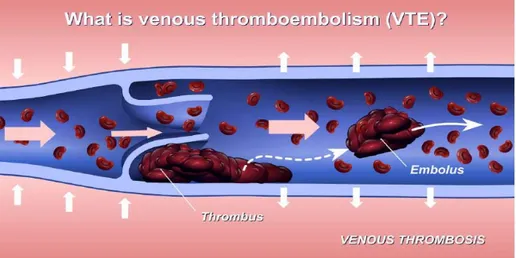 Figure 5 : Thrombose Veineuse Profonde et Embolie [19].  2.3  Conséquences hémodynamiques de l’EP : 