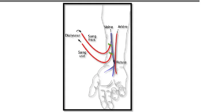 Figure 3 : Schéma d’une fistule artério-veineuse distale avec insertion des aiguilles au niveau  de la veine radiale 