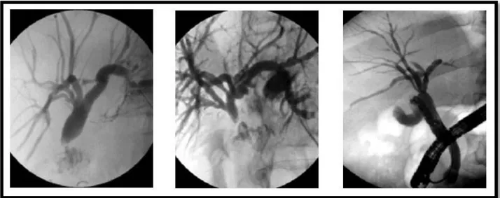 Figure 3: Cholangiographies directes percutanées ou rétrograde : variations anatomiques  complexes d'abouchement des voies biliaires intrahépatiques droites