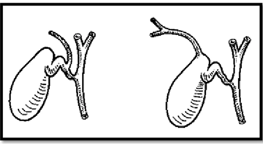 Figure 5:  Représentation schématique des variations d'abouchement de voies biliaires  intrahépatiques droites dans le collet vésiculaire ou dans le canal cystique