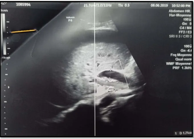 Figure 21: Echographie abdominale: Dilatation de la voie biliaire principale mesurant 17mm de  diamètre sans obstacle décelable 