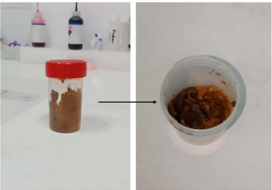Figure 2 : Examen macroscopique d’un échantillon de selles recueilli au cours de notre étude  (Laboratoire de parasitologie-mycologie de l’Hôpital Militaire Avicenne de Marrakech) 