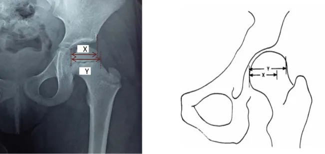 Figure 1: Mesure de l’index acétabulaire x/y [7]. 