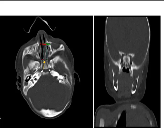 Figure 11: Une nouveau-née à j3 de vie qui a présenté une détresse respiratoire néonatale  TDM faciale en coupes axiales et reconstruction coronale 