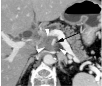 Figure 21 : TDM abdominale, coupe axiale. Tumeur du crochet pancréatique avec  engainementcircoférentiel (têtes de flèche) de l’AMS (flèche)