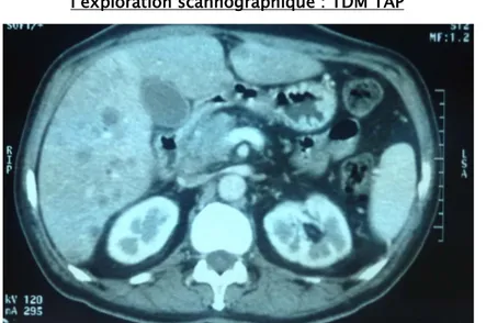 Figure 24: TDM abdominale, coupe axiale : Tumeur de la tête du pancréas avec plusieurs nodules  hépatiques secondaires