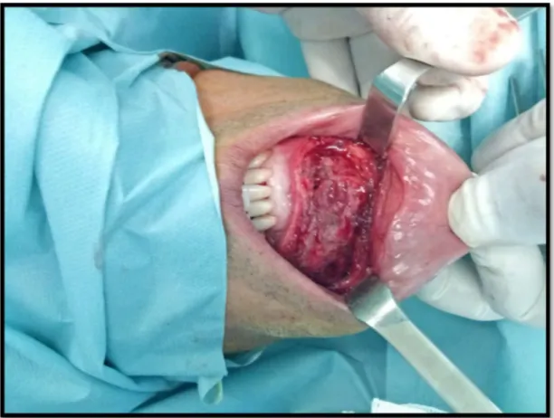 Figure 18 : Photo en per-opératoire d’un patient montrant l’abord chirurgical vestibulaire  (Iconographie du service maxillo-facial hôpital militaire Avicenne Marrakech)  3