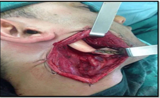 Figure 24 :photo en per-opératoire montrant une reconstruction d’une mandibulectomie  terminale par endoprothèse fixée par plaque d’ostéosynthèse (Iconographie du service 