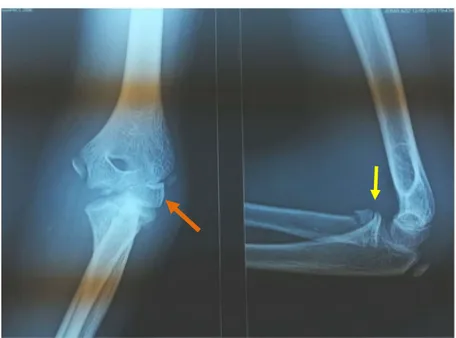 Figure 11: Radiographie du coude F/P chez un enfant âgée de 13 ans objectivant une fracture de  la tête radiale stade II (fleche jaune )associée à une fracture de l’épitrochlée (flèche jaune) 