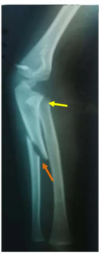 Figure 12 : Radiographie profil du coude chez un enfant âgé  de 5 ans objectivant une fracture  de la  tête radiale stade I(fléche jaune) associée a une fracture du diaphyse ulnaire(fléche orange) 
